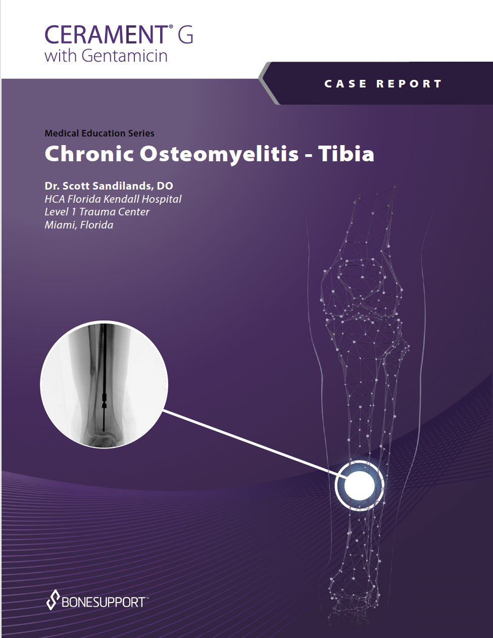 Chronic Osteomyelitis – Tibia